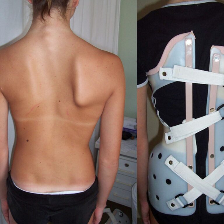 Skolióza u detí                                                        alebo čo by mali rodičia vedieť